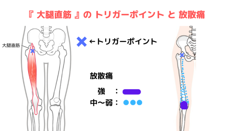 大腿直筋のトリガーポイントと放散痛を解説
