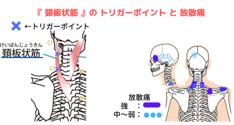 頸板状筋のトリガーポイントと放散痛