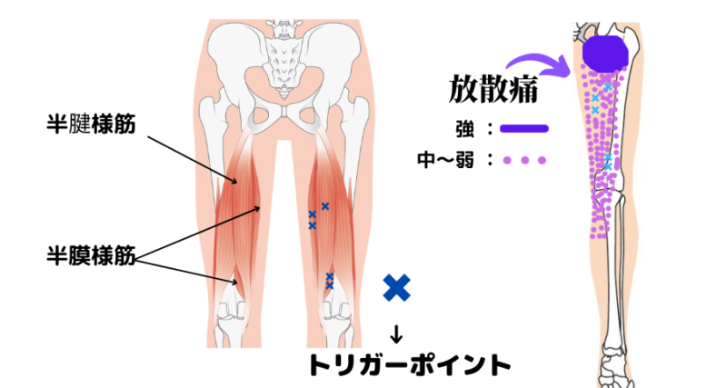半腱様筋と半膜様筋のトリガーポイントと放散痛