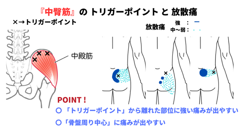 中臀筋のトリガーポイントと放散痛の解説図